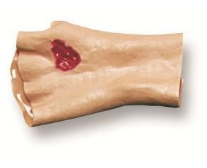 Phosphorous Burn Of Hand < simulaids #6801 