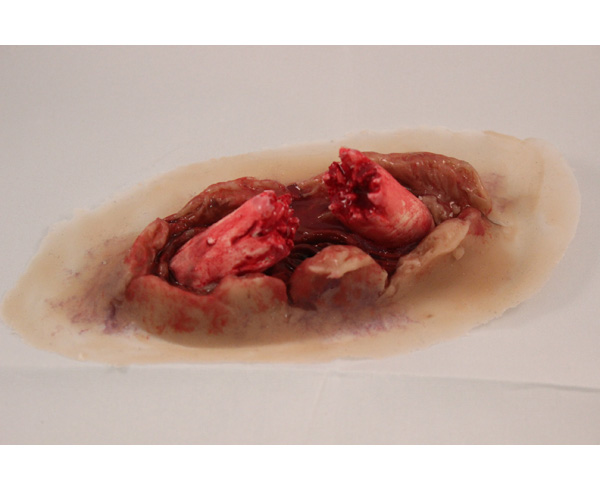 Compound Fracture/Non-Dynamic (4) < #TMK-EPS-09-02-04 