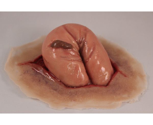 Perforated Bowel < #TMK-EPS-39-01 