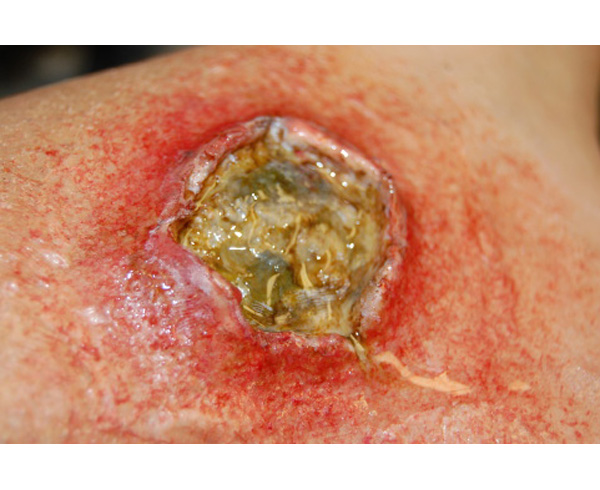 Ulcer (Small) (6) < #TMK-EPS-46-01-06 