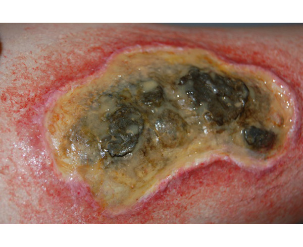 Ulcer (Large) (4) < #TMK-EPS-45-01-04 