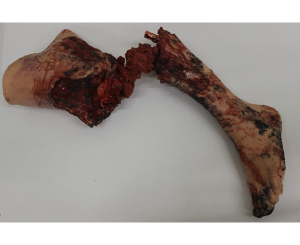 Partial Leg Amputation (Left) < #TMK-EPS-33-01 