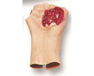 Gunshot Wound Of The Palm < simulaids #6881 