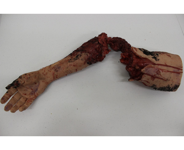 Partial Arm Amputation (Right) < #TMK-EPS-31-02 