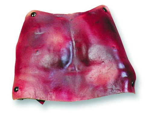 Casualty & Moulage 2nd & 3rd Degree Burns, Chest < simulaids #6724 