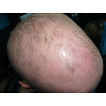 Alopecia client
