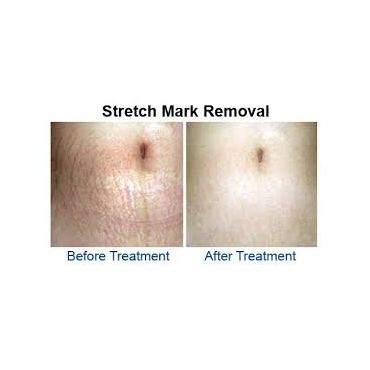 Stretch mark Treatment
