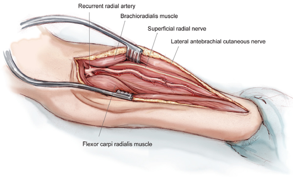 Image result for Coronary Artery Bypass- Symptoms and Treatments