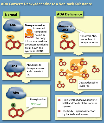 adenosine deaminase deficiency by shaheera khalid infographic