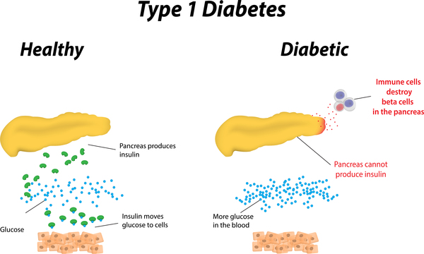 genetically engineered insulin by chloe chang infographic difference between type1 and type 2 diabetes venn diagram