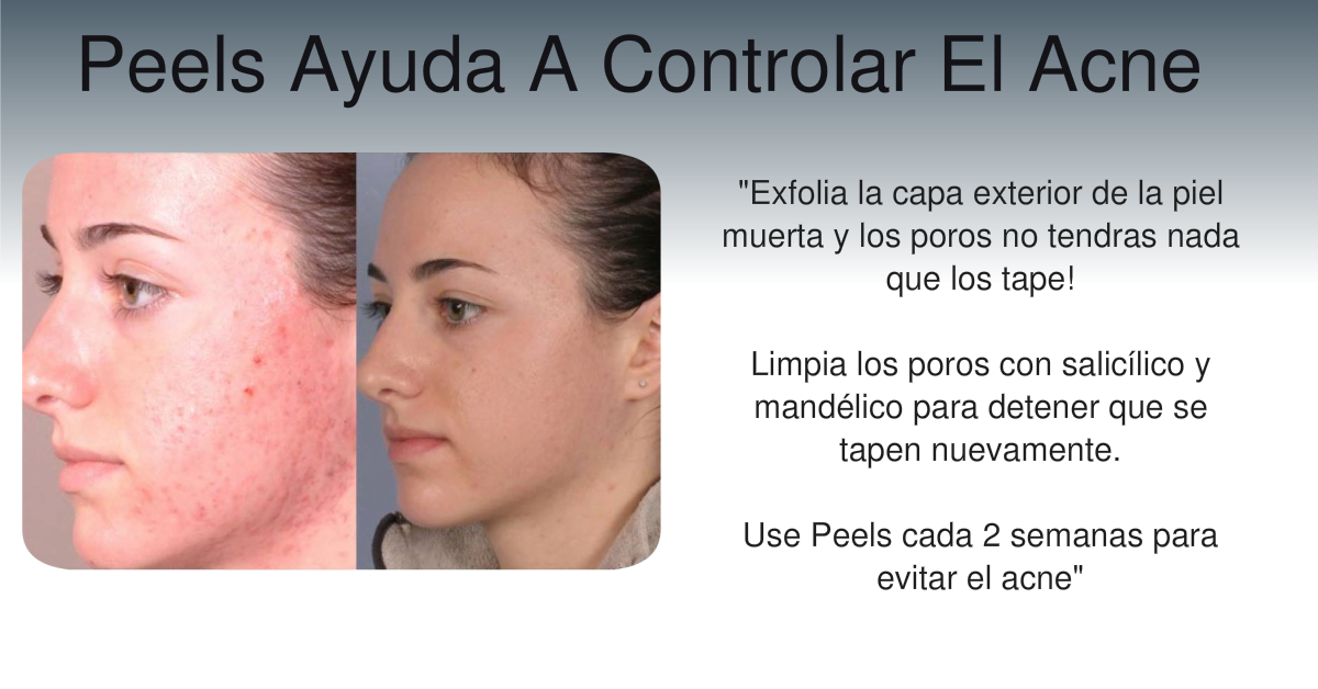 DuoPeelsAcne