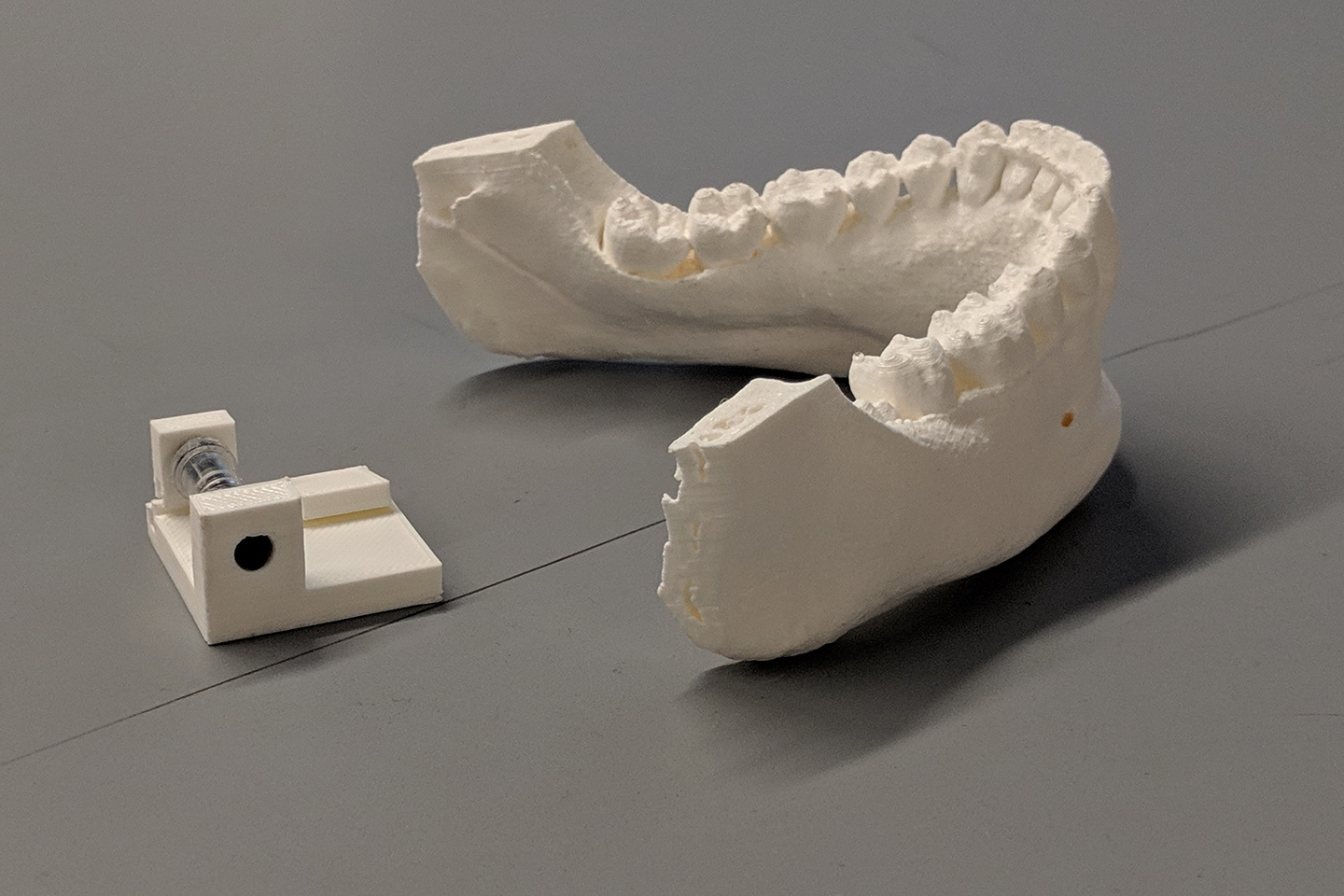 A prototype of a mouthguard to assist with treating epilepsy.