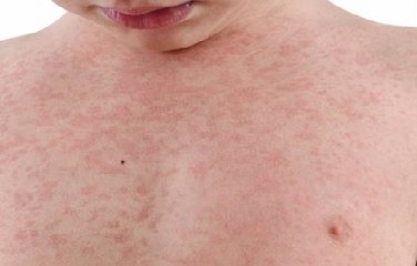  O alerta foi feito pela assessora regional de Imunizações da entidade