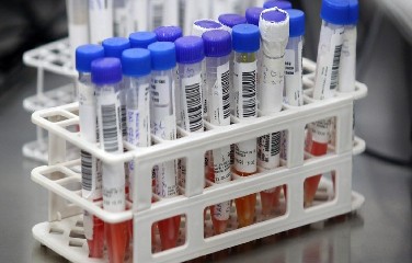 Ranking da Universidade Johns Hopkins ainda aponta que país é o sexto em número de mortes pelo novo coronavírus