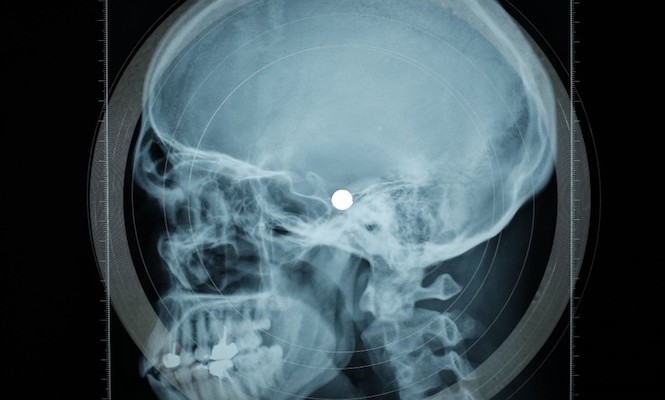 torture-victim-testimonies-x-rays
