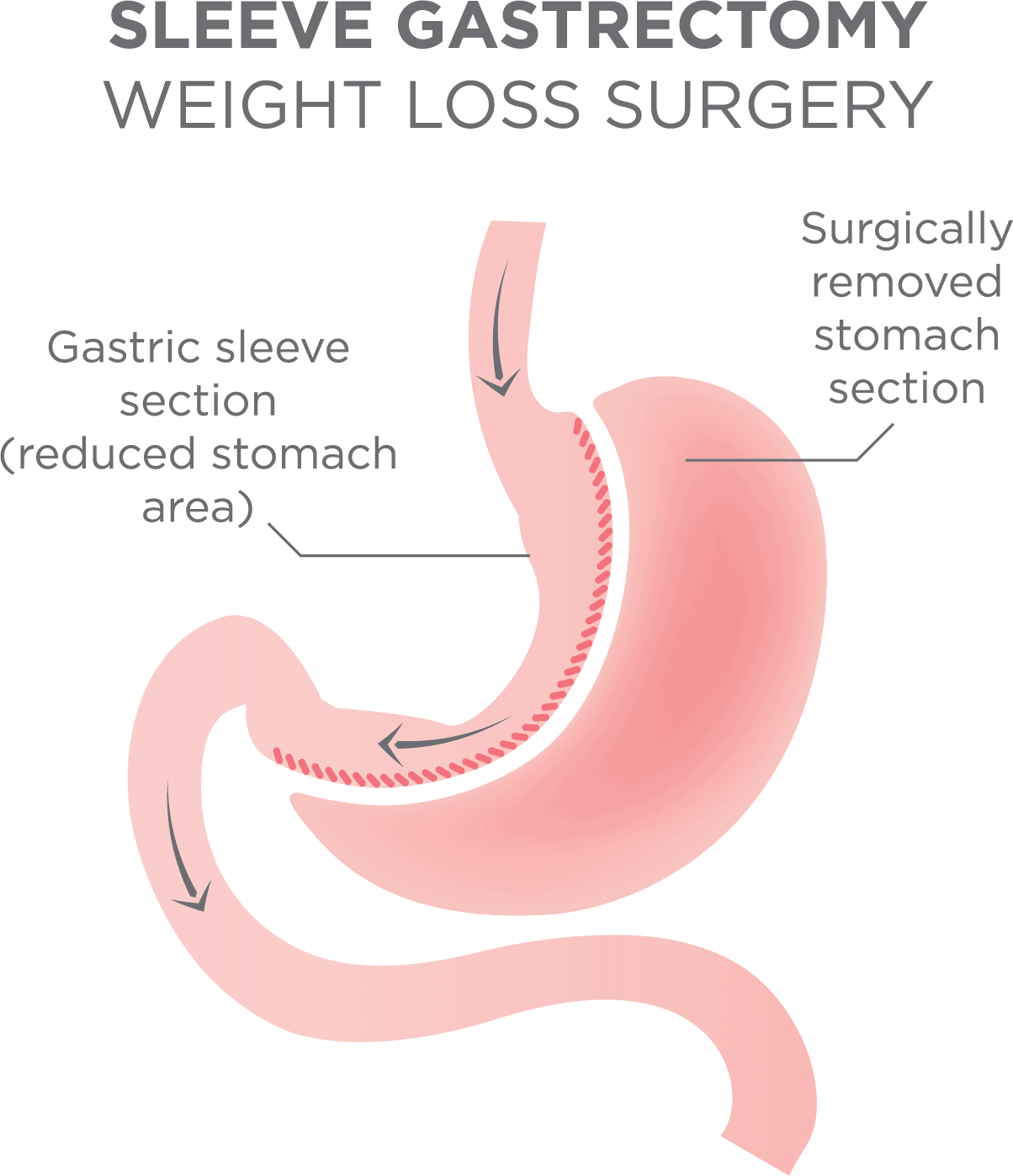Best Vitamins After Bariatric Surgery