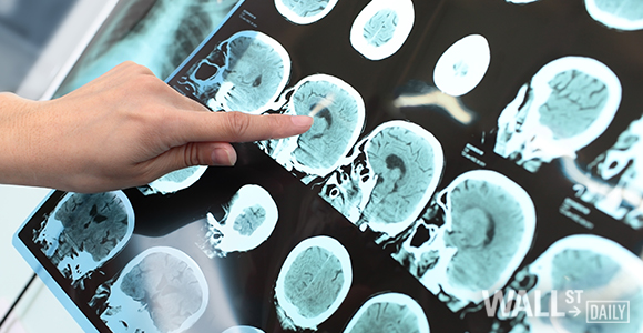 Alzheimer’s Disease: Does THC Hold the Key to a Cure?