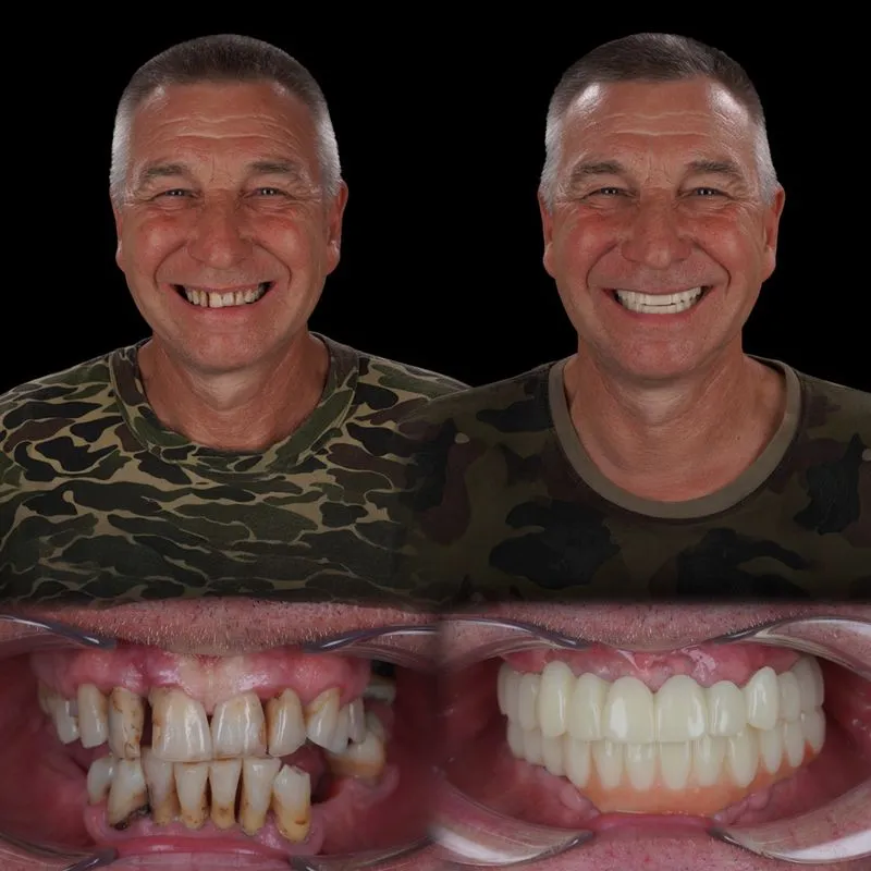 Rezultat pacient before/after