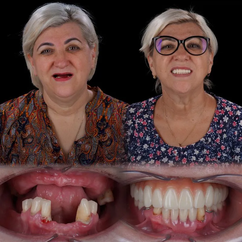 Rezultat pacient before/after