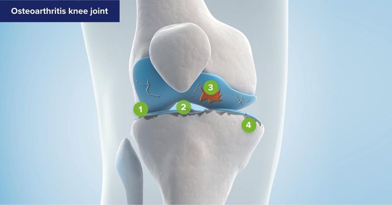 Knee osteoarthritis pain