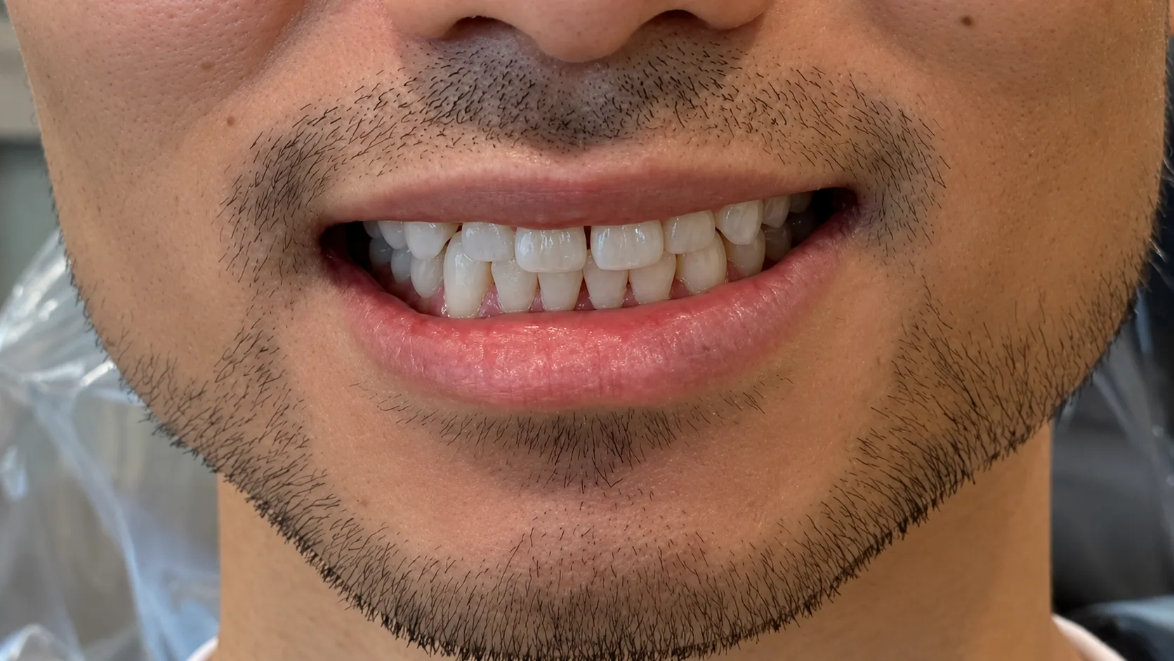 Invisalign Transformation before treatment at Flawless Dental Studio
