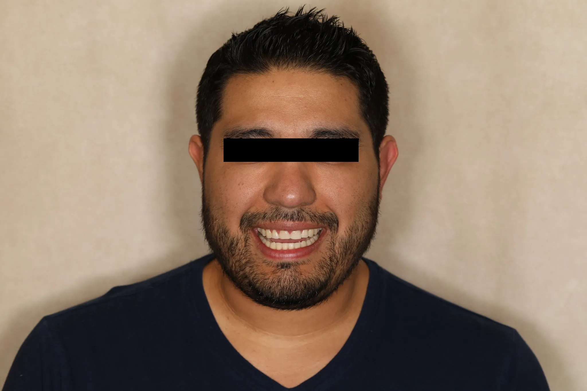 Comprehensive smile makeover — patient’s before smile portrait, eyes covered