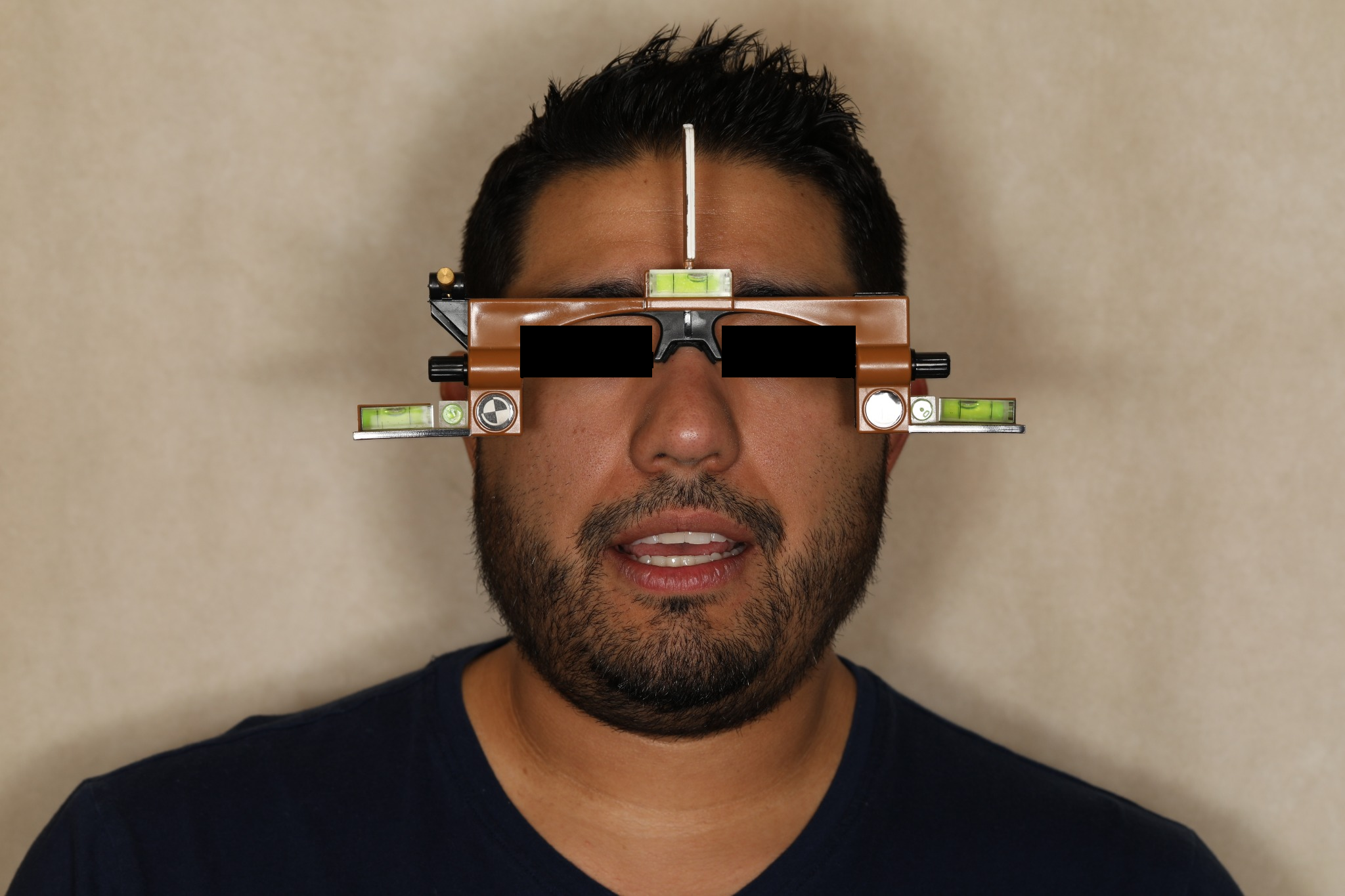Patient’s pretreatment facial reference record, eyes covered
