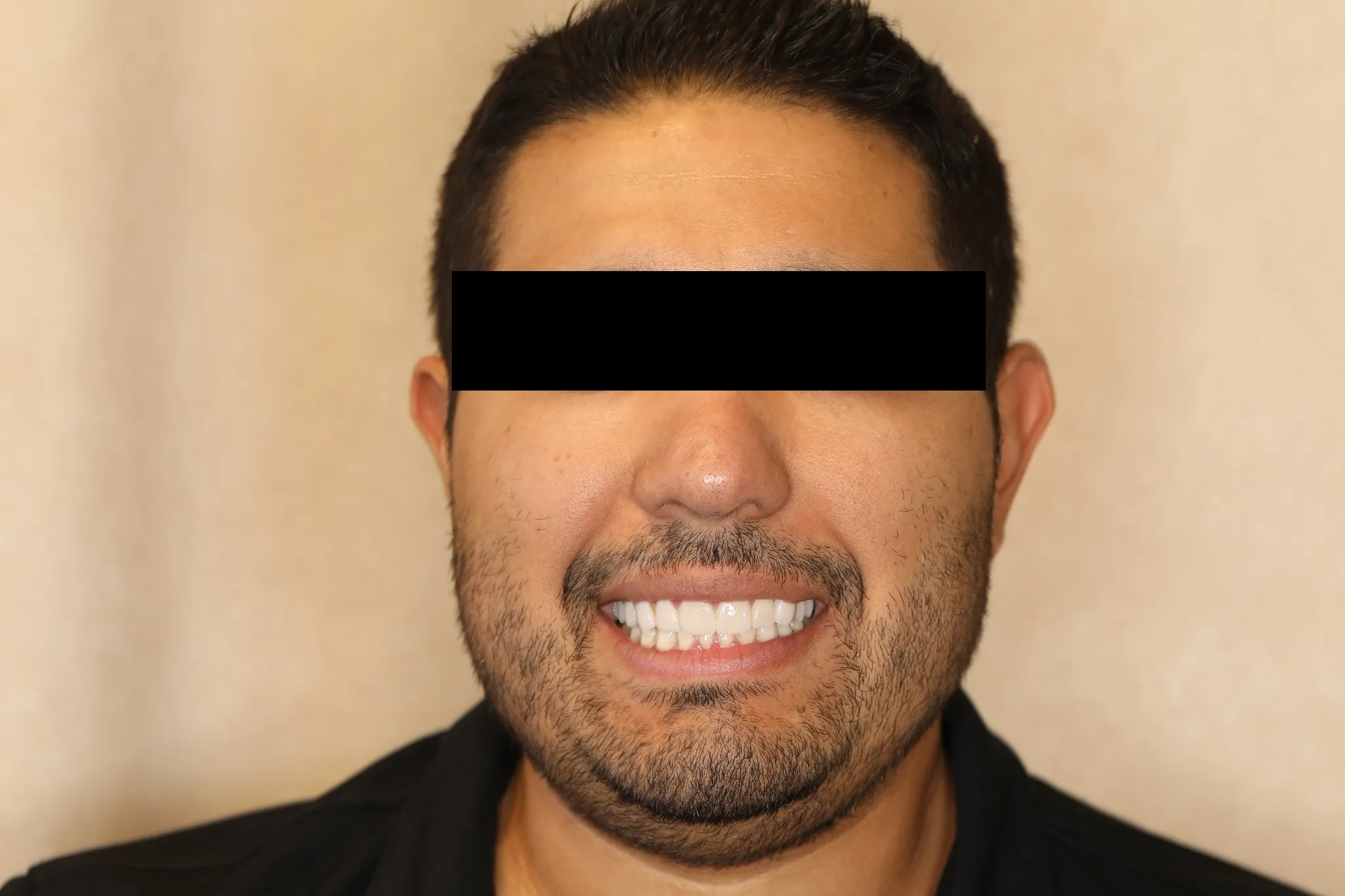 Featured comprehensive smile makeover — final patient portrait with eyes covered