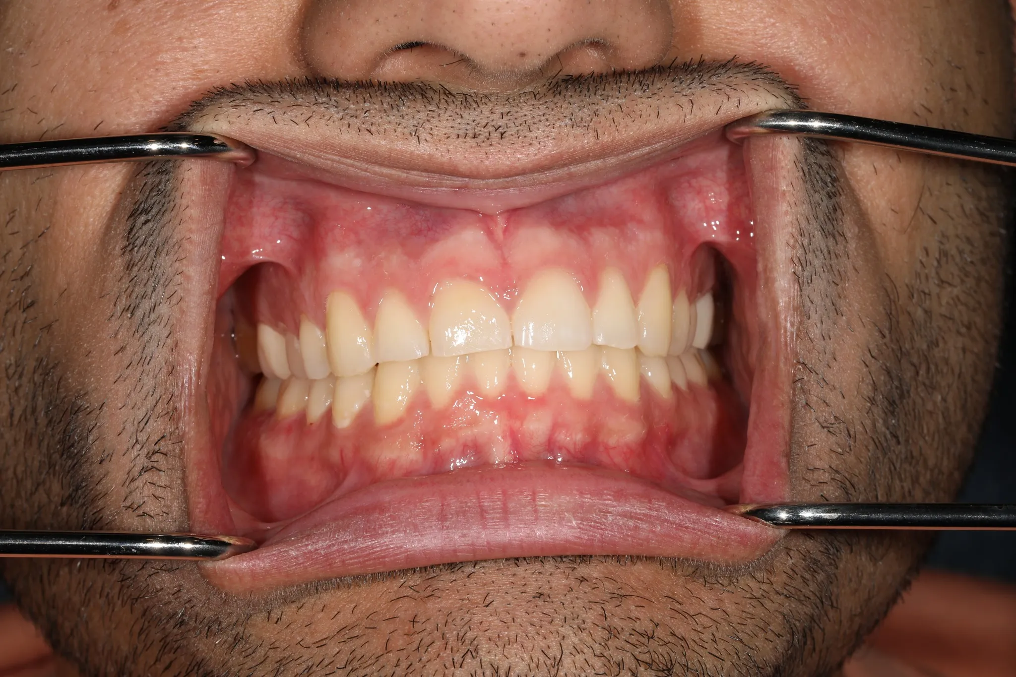 Comprehensive smile makeover — same patient's teeth together before treatment