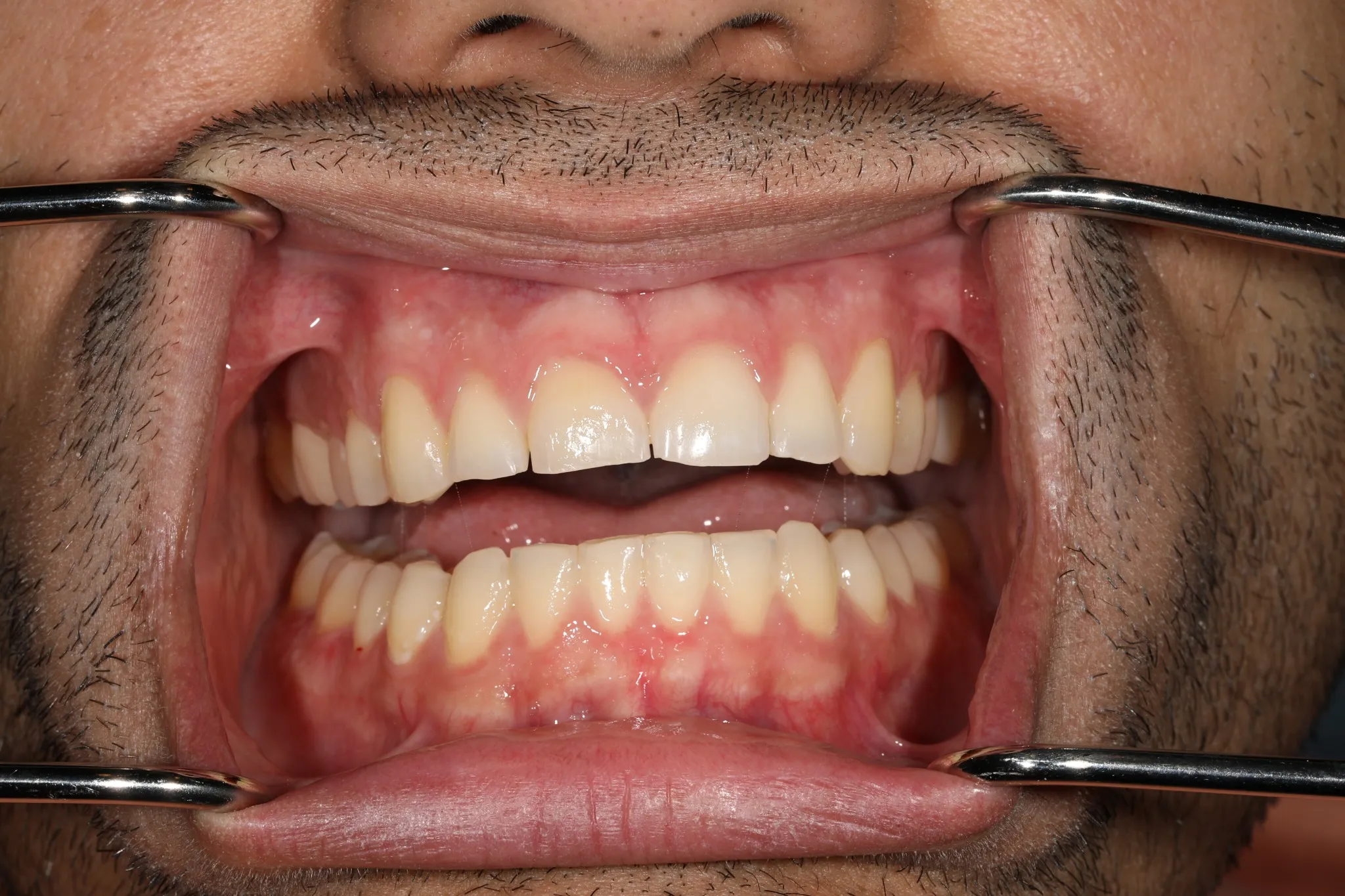 comprehensive smile makeover upper and lower veneers — before treatment