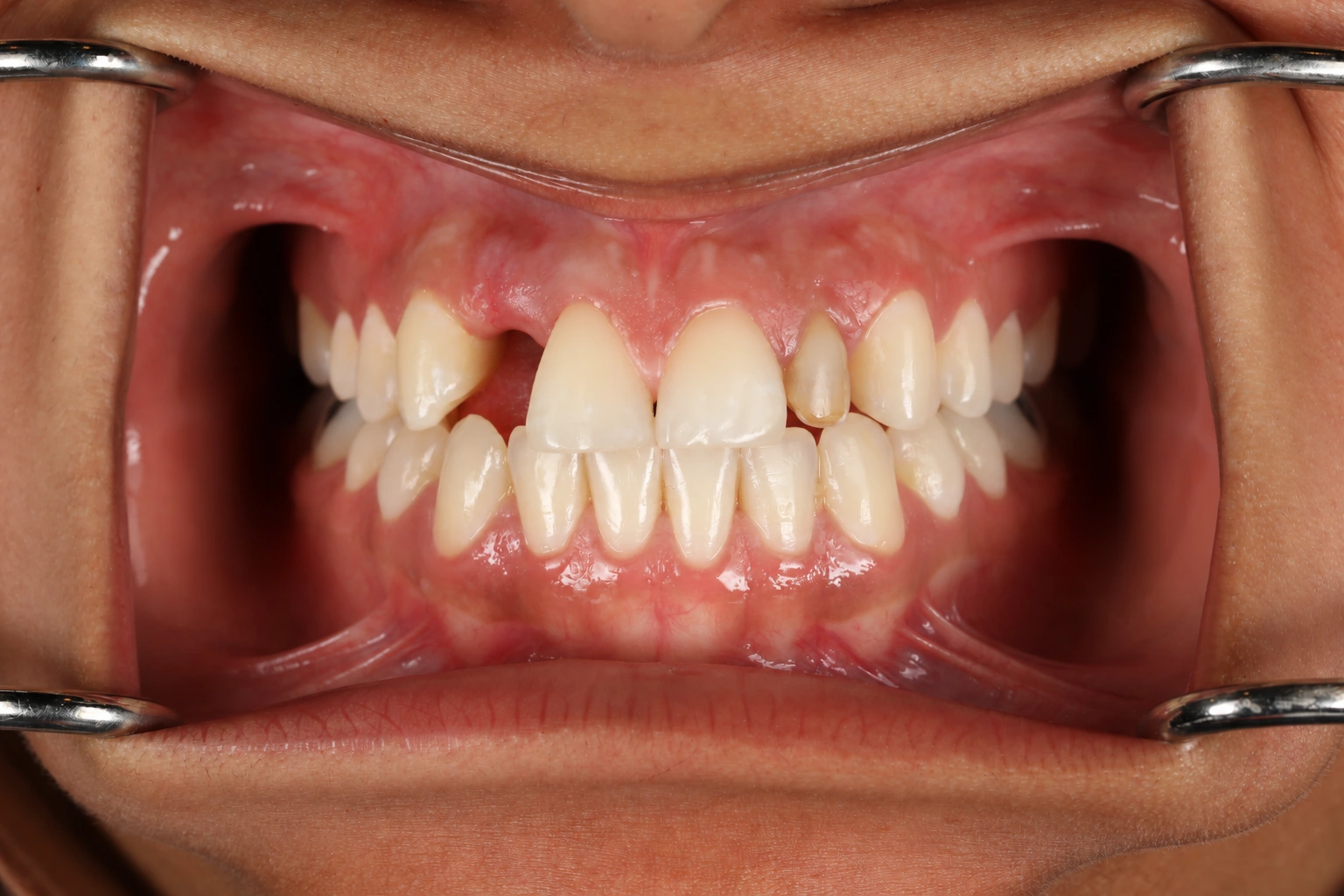 Before treatment: missing upper right lateral incisor and retained primary lateral incisor on the opposite side