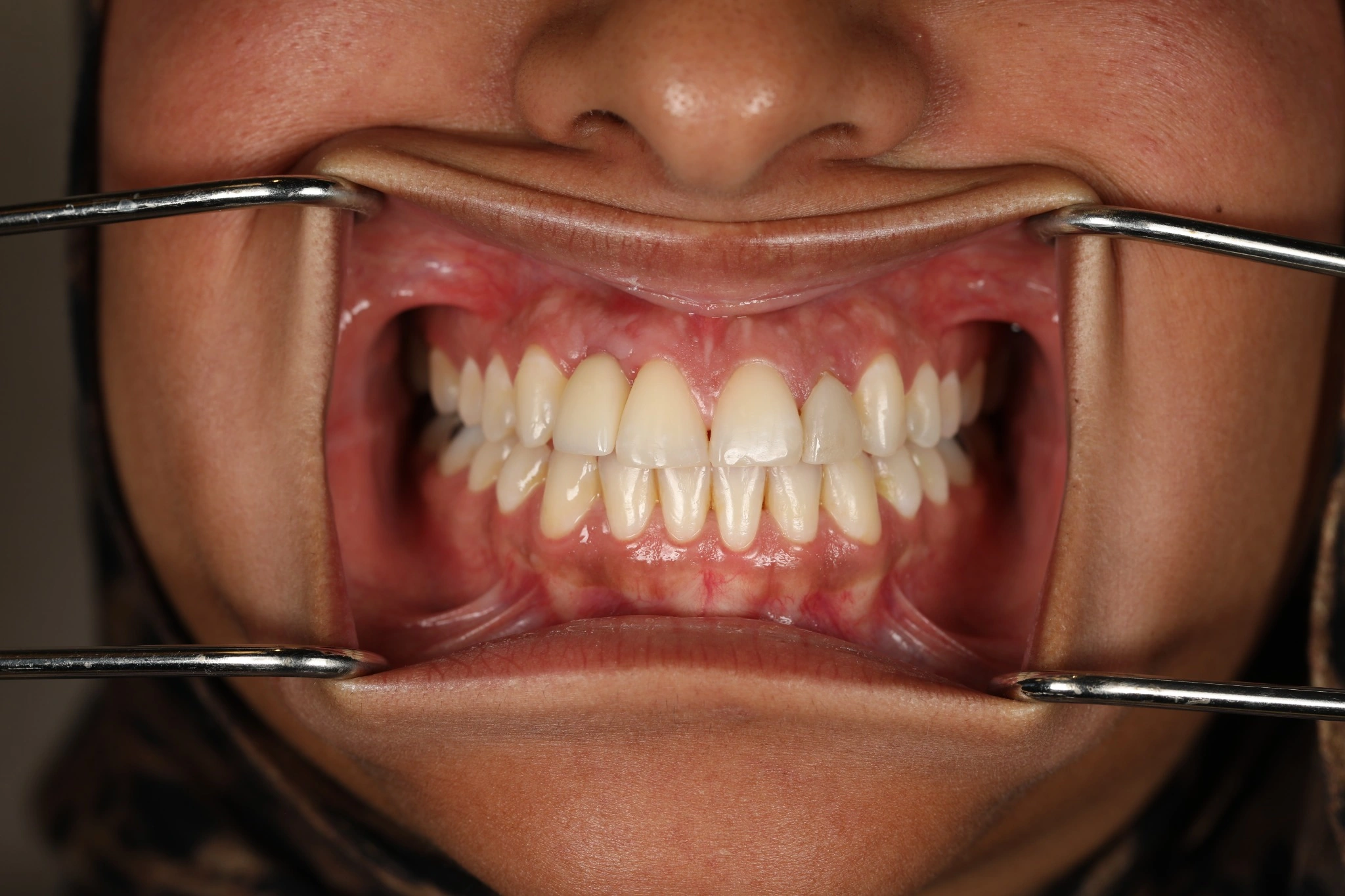 After the current treatment stage: implant restoration at site 7 and resin composite on retained primary tooth G