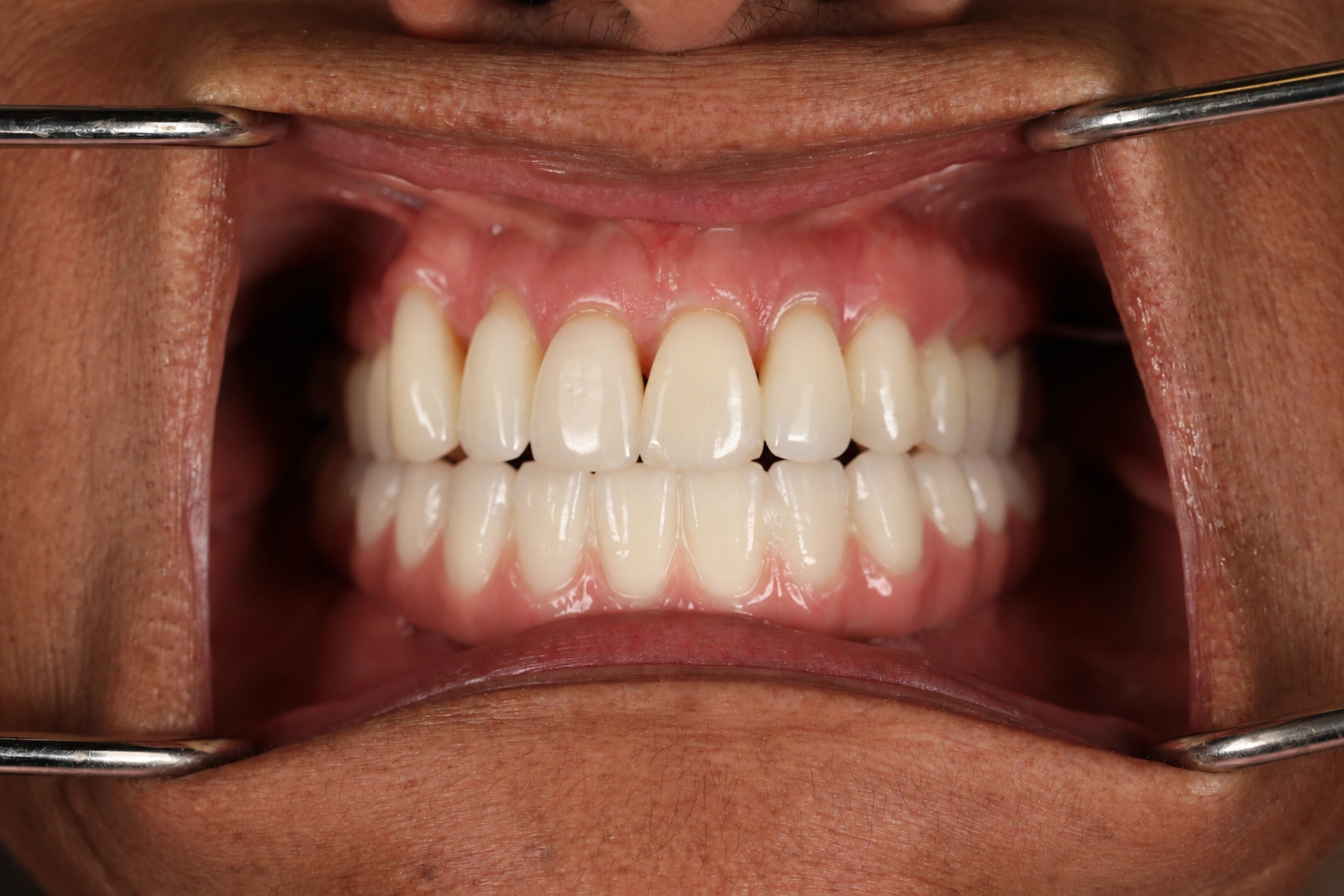 Clinical view after lower All-on-X restoration