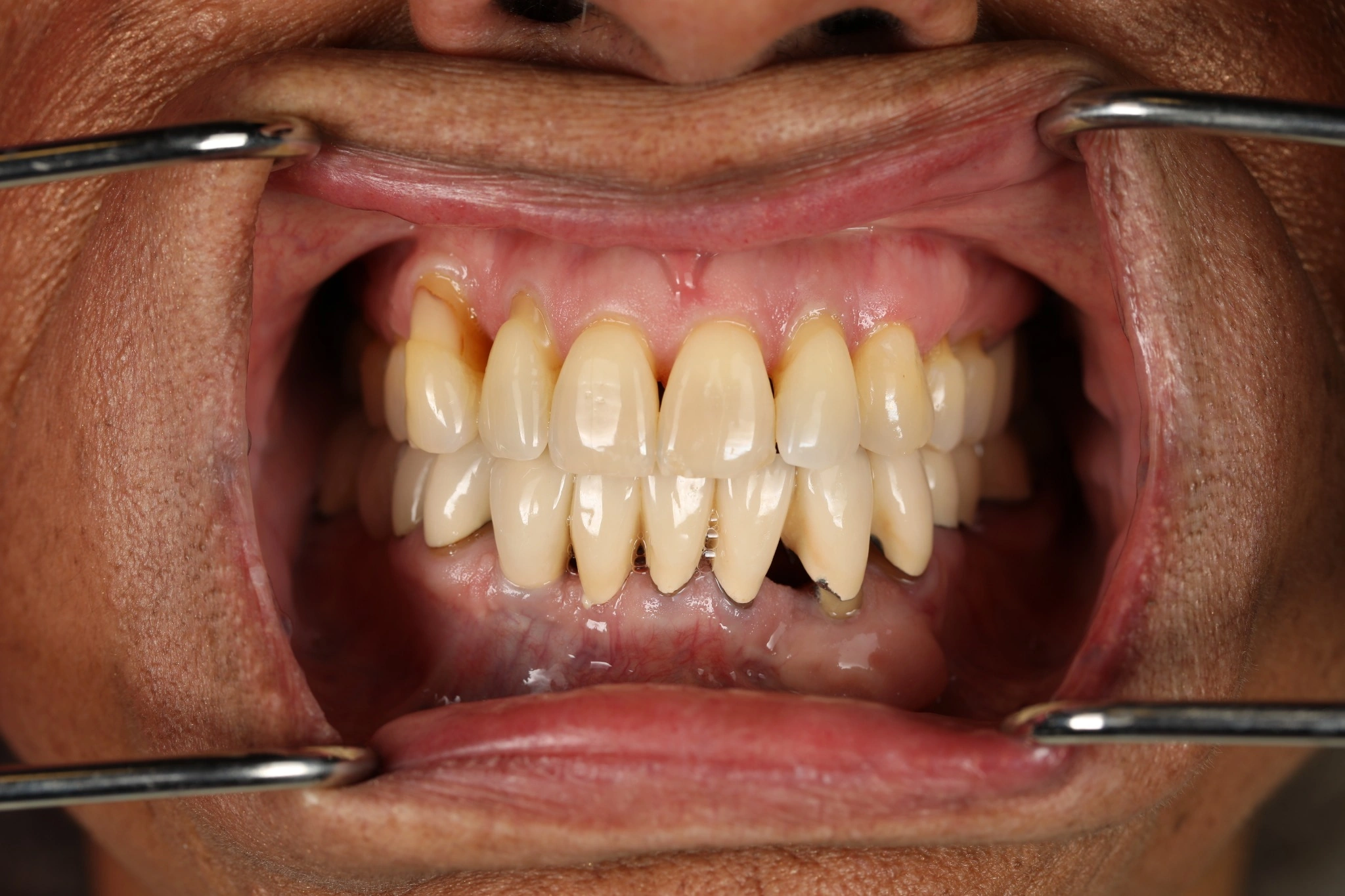 Clinical view before lower All-on-X treatment, showing the existing lower teeth and restorations