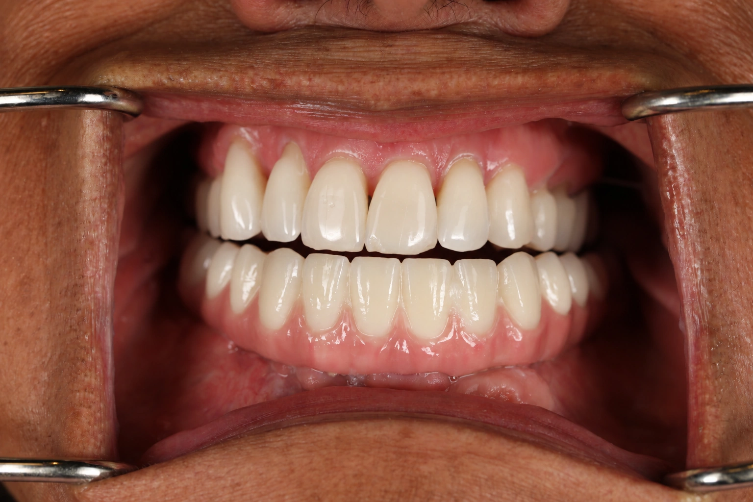 Open clinical view after lower full-arch restoration