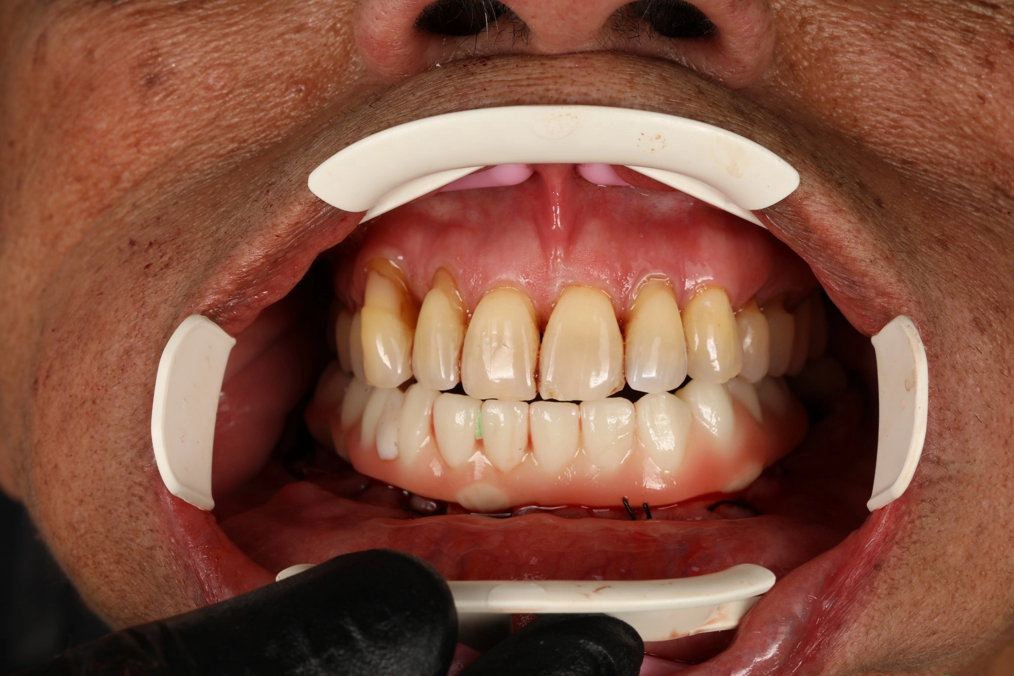Lower All-on-X temporary prosthesis placed on the day of guided implant surgery