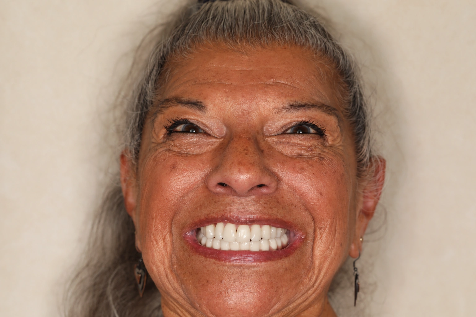 Smile photograph after lower All-on-X restoration