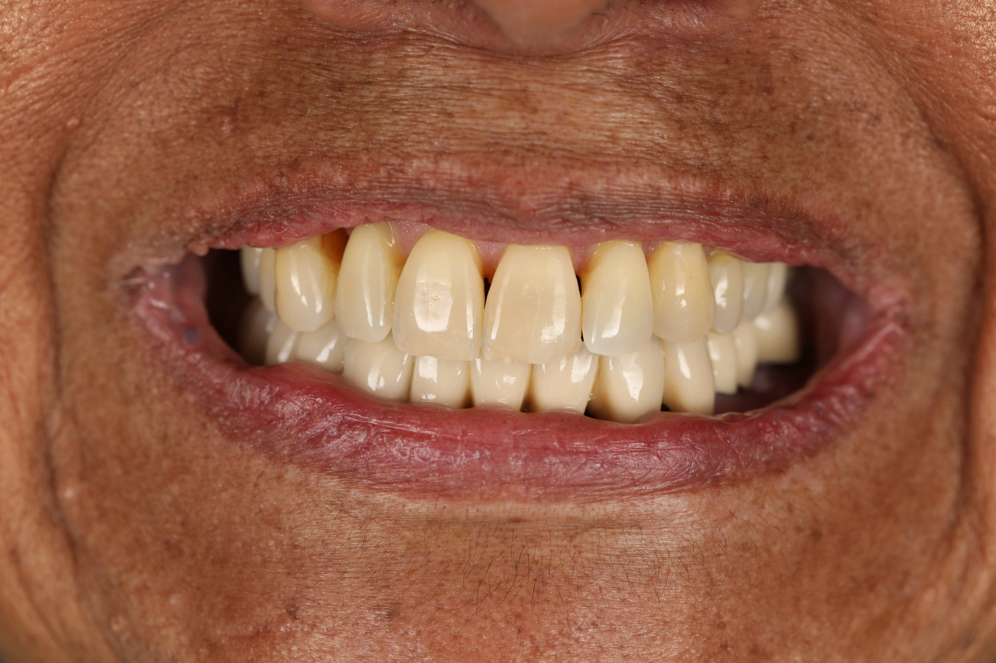 Smile photograph before lower All-on-X treatment
