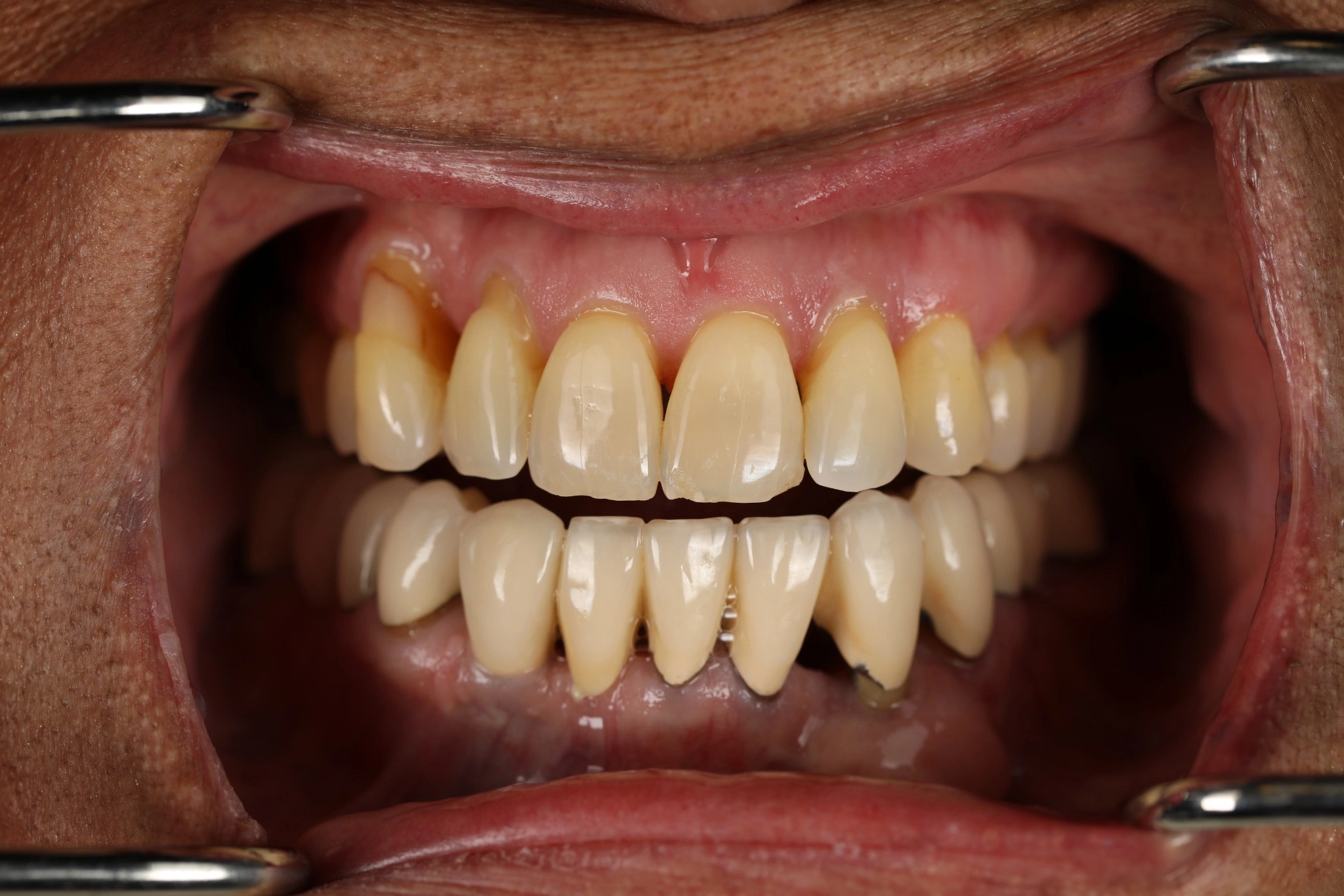 Open clinical view of the teeth before lower full-arch implant treatment