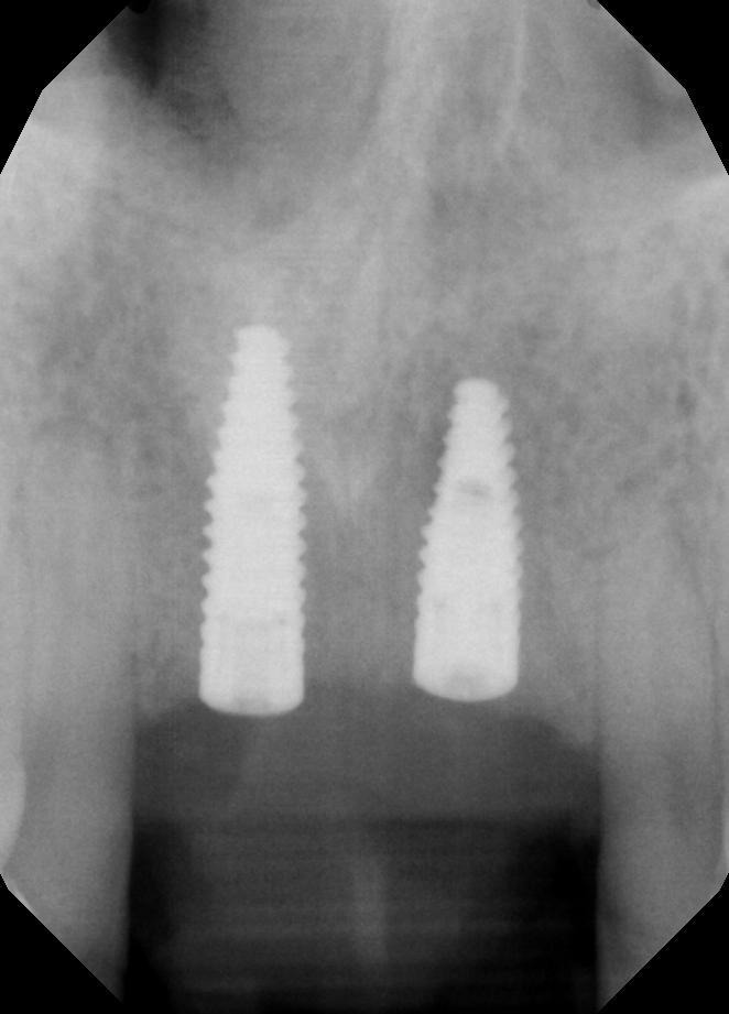 Radiograph showing the two upper front dental implants