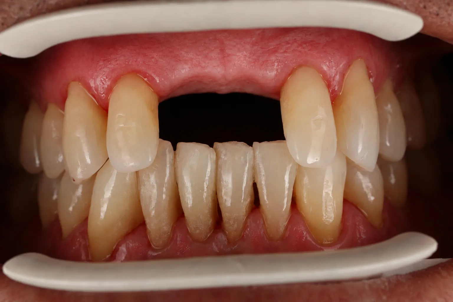 Reconstructed view of the starting condition with two missing upper front teeth