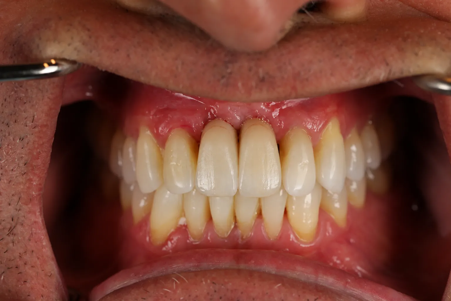 Visualization of the two upper front replacement teeth