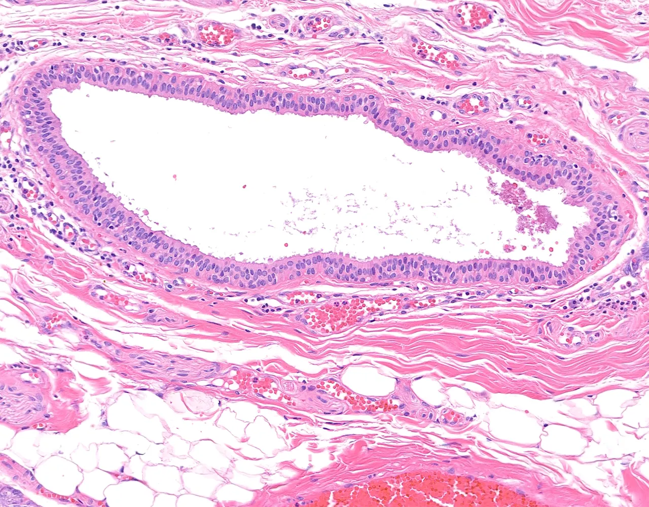 Large interlobular ducts are located within dense collagenous connective tissue septa and often show a wide, irregular lumen.