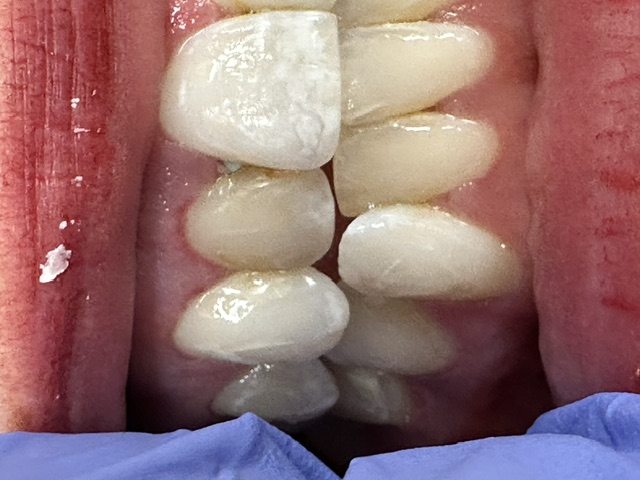 Case 1: before dental treatment