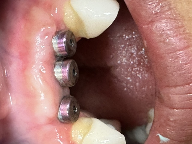 Case 6: before dental treatment