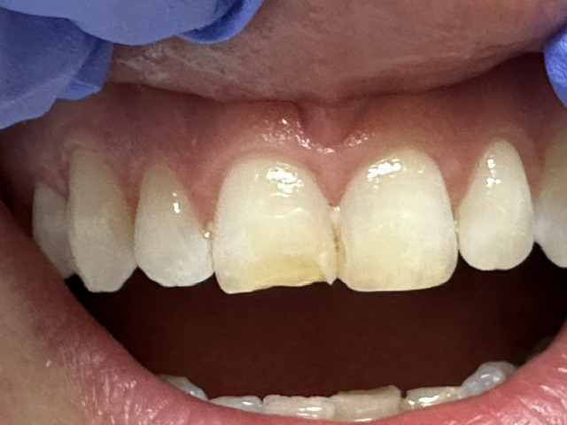 Case 4: before dental treatment
