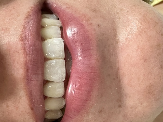 Case 1: after dental treatment