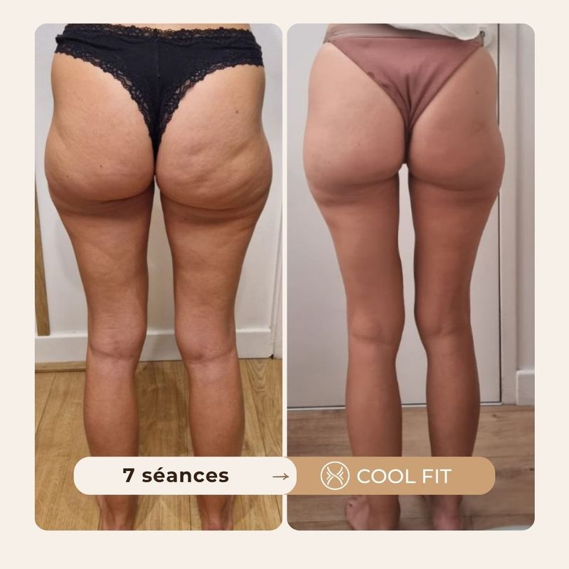 Avant après cellulite Cool Fit
