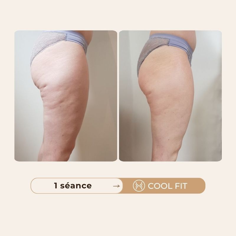 Avant après cellulite Cool Fit