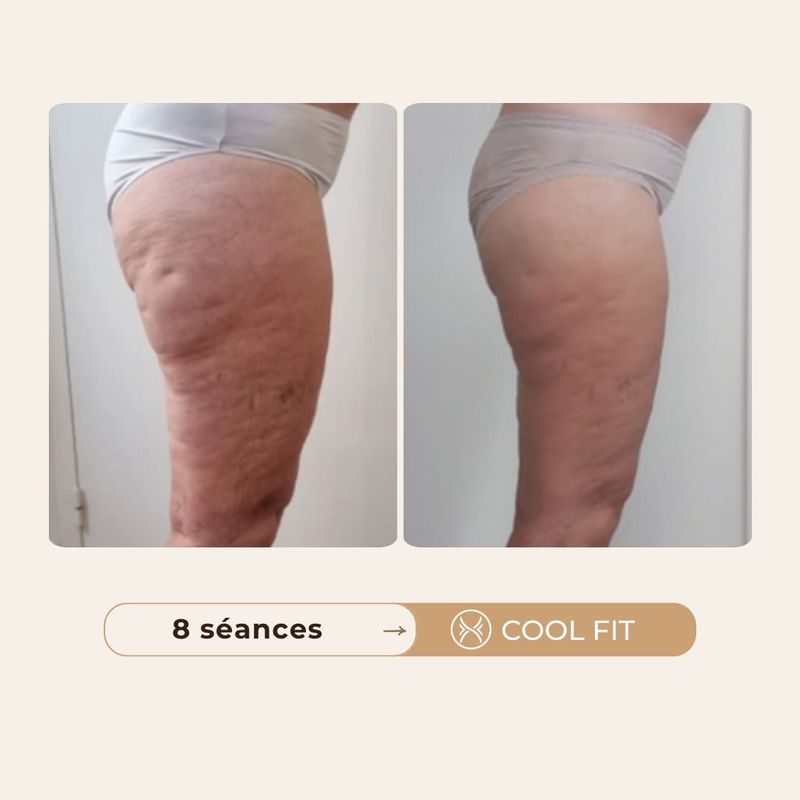 Avant après cellulite Cool Fit